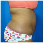 Liposuction Before & After Patient #312