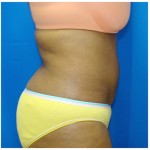Liposuction Before & After Patient #312