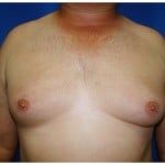 Liposuction Before & After Patient #315