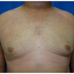 Liposuction Before & After Patient #315