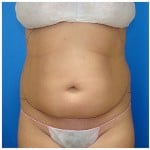 Liposuction Before & After Patient #267