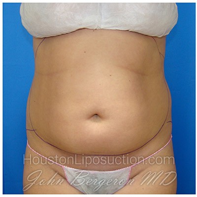 Liposuction Before & After Patient #267