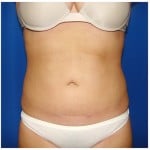 Liposuction Before & After Patient #267