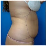 Liposuction Before & After Patient #267