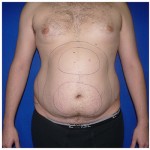 Liposuction Before & After Patient #272