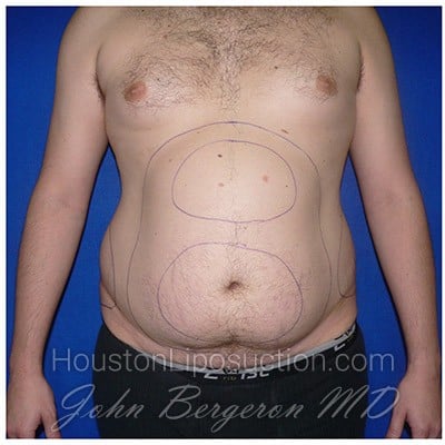 Liposuction Before & After Patient #272