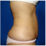Liposuction Before & After Patient #328