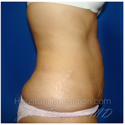 Liposuction Before & After Patient #328