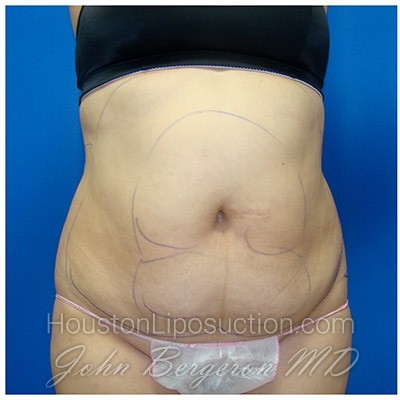 Liposuction Before & After Patient #331