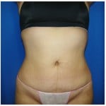 Liposuction Before & After Patient #331