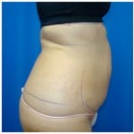 Liposuction Before & After Patient #331