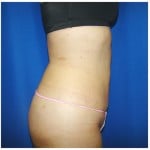 Liposuction Before & After Patient #331