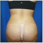 Liposuction Before & After Patient #331