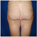 Liposuction Before & After Patient #341