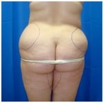 Liposuction Before & After Patient #347