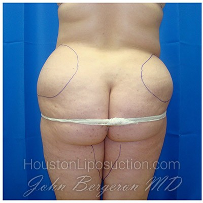 Liposuction Before & After Patient #347