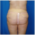 Liposuction Before & After Patient #347