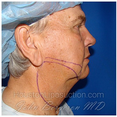 Liposuction Before & After Patient #353