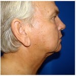 Liposuction Before & After Patient #353