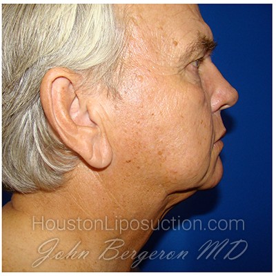 Liposuction Before & After Patient #353