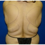 Liposuction Before & After Patient #356