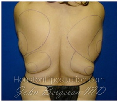 Liposuction Before & After Patient #356