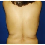 Liposuction Before & After Patient #356