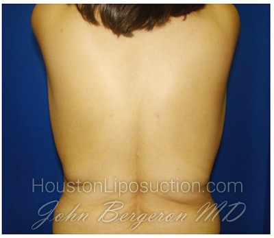 Liposuction Before & After Patient #356