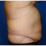 Liposuction Before & After Patient #359