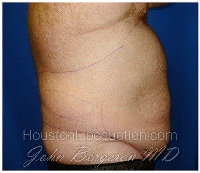 Liposuction Before & After Patient #359