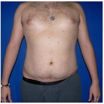 Liposuction Before & After Patient #272