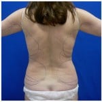 Liposuction Before & After Patient #275