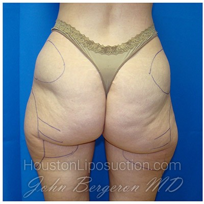 Liposuction Before & After Patient #362