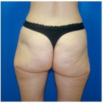Liposuction Before & After Patient #362