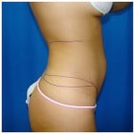 Liposuction Before & After Patient #366