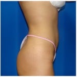 Liposuction Before & After Patient #366