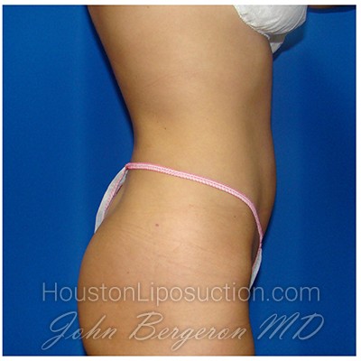 Liposuction Before & After Patient #366