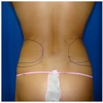 Liposuction Before & After Patient #366