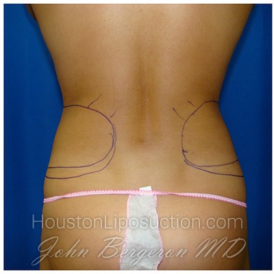 Liposuction Before & After Patient #366