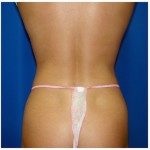 Liposuction Before & After Patient #366