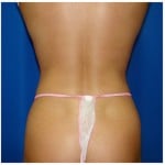 Liposuction Before & After Patient #366