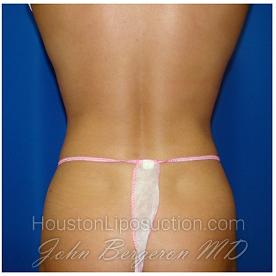 Liposuction Before & After Patient #366