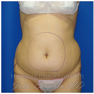 Liposuction Before & After Patient #375