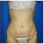 Liposuction Before & After Patient #375