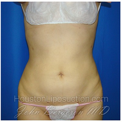 Liposuction Before & After Patient #375