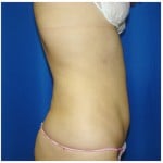 Liposuction Before & After Patient #375