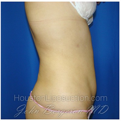 Liposuction Before & After Patient #375