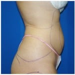 Liposuction Before & After Patient #380