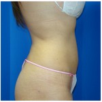 Liposuction Before & After Patient #380