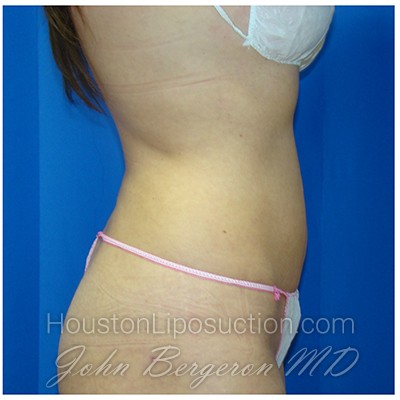 Liposuction Before & After Patient #380